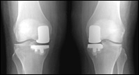 UniCompartmental Total Knee Replacement